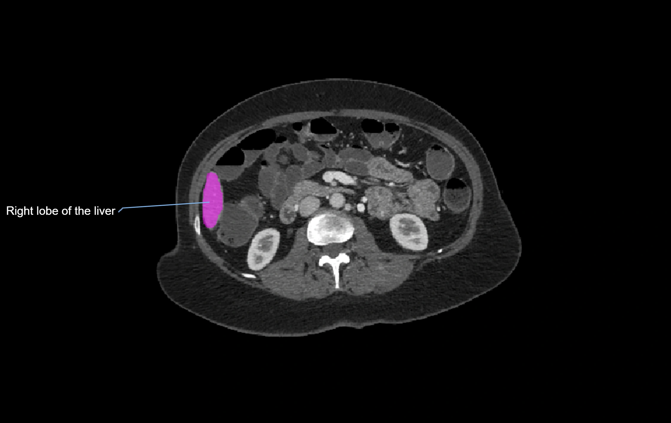 CT lliver lobes axial cross sectional anatomy labelled image -00008.webp